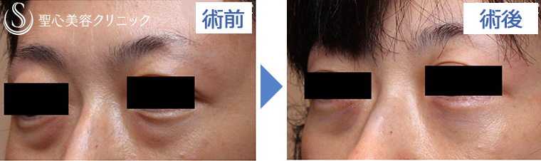 症例写真 比較 目のくま・くぼみ・たるみ・眼瞼下垂