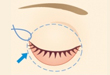 下眼瞼切開／下眼瞼除皺術／ハムラ法