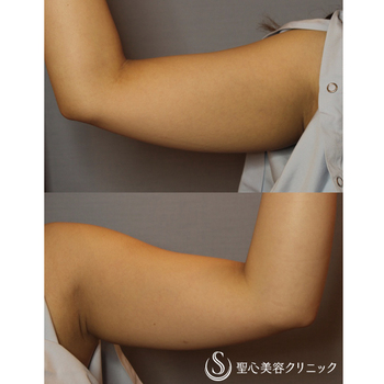 症例写真 術前 ベイザーリポ2.2脂肪吸引 二の腕