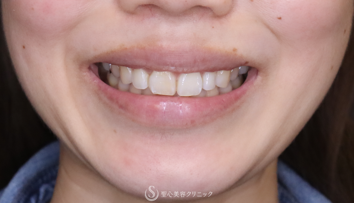 ガミースマイル（歯肉短縮術単独）_After