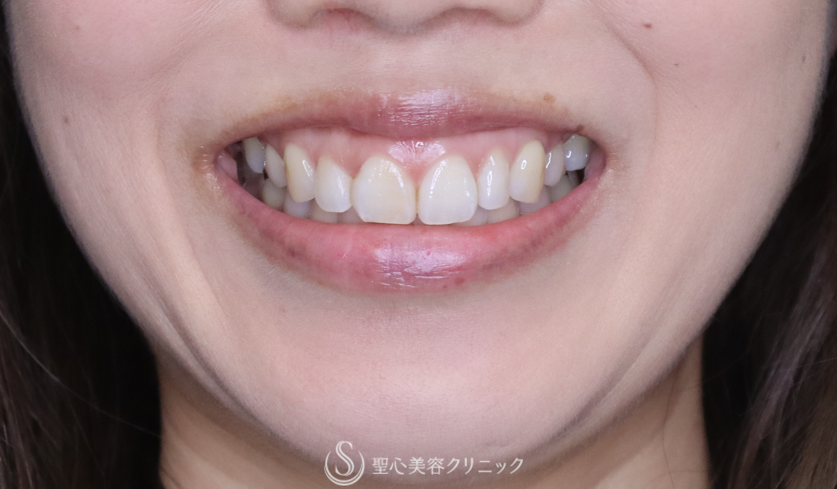 ガミースマイル（歯肉短縮術単独）_Before