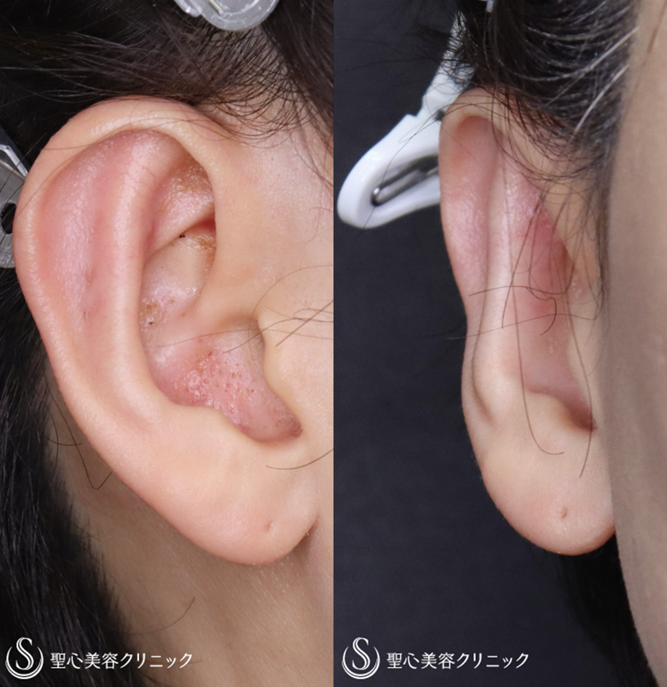 立ち耳修正（埋没法）_After