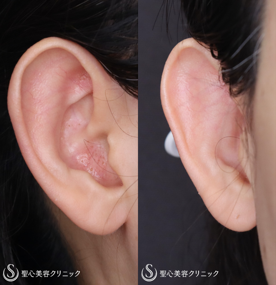 立ち耳修正（埋没法）_Before